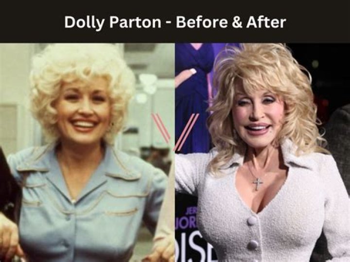 Dolly Parton: Uncovering The Truth About Implants