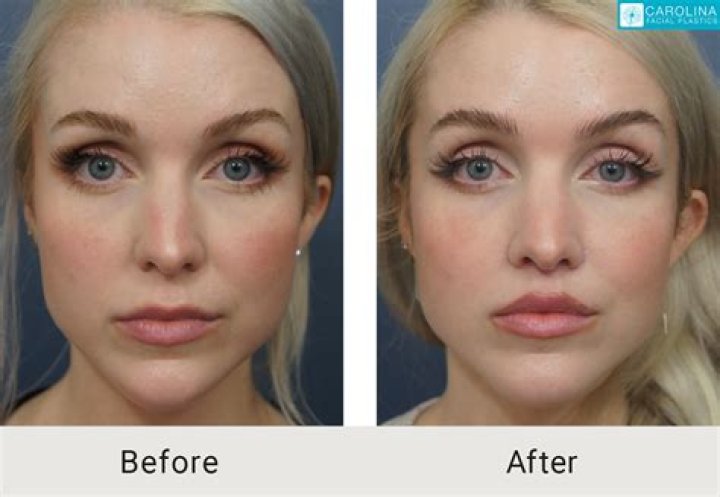 Dove Cameron's Natural Beauty: Before And After Lip Fillers