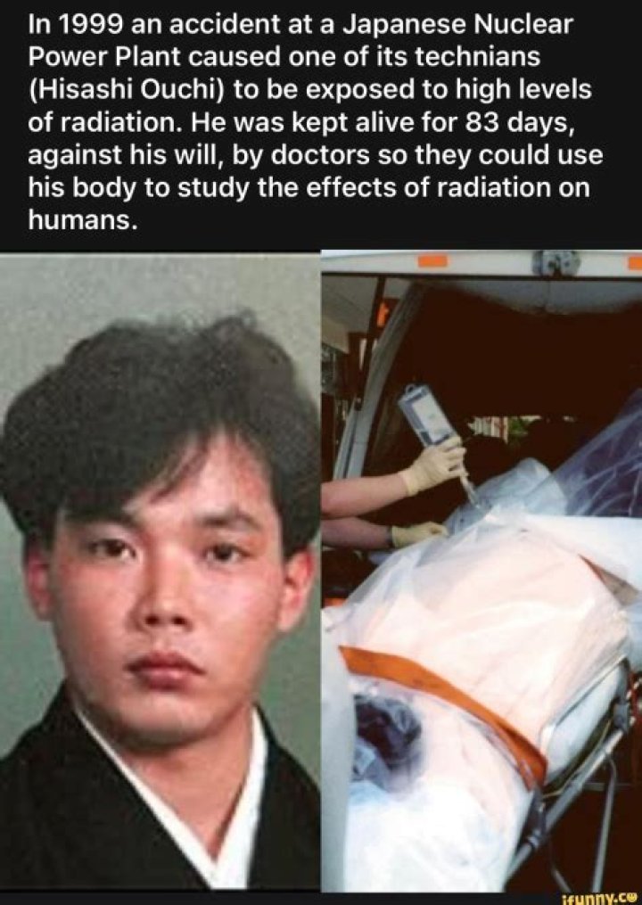 Hisashi Ouchi: The Horrific Aftermath Of Radiation Exposure