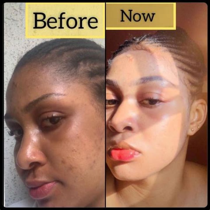 Skin Transformation: Nicki Minaj's Before And After Bleaching
